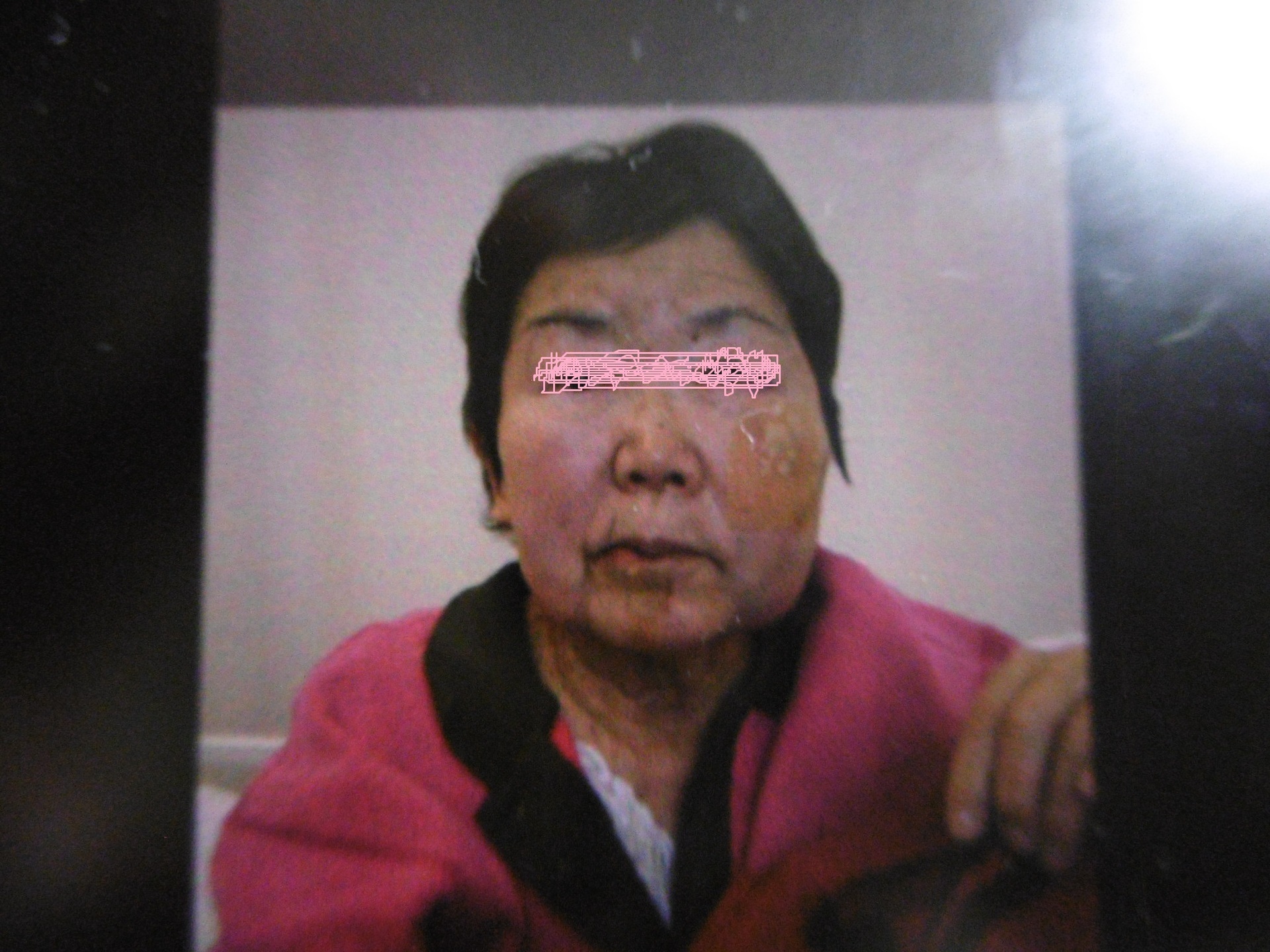 76歳の母 交通事故 顔面骨折とくも膜下出血